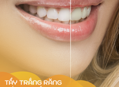 Tẩy trắng răng có hại không? Hiểu đúng để yên tâm thực hiện