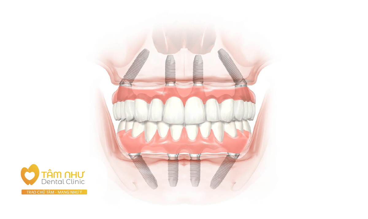 Cấy ghép Implant phục hình  All-on 4 toàn hàm cố định thay thế toàn bộ răng - Nha Khoa Tâm Như - Quận 10 - Tp. Hồ Chí Minh