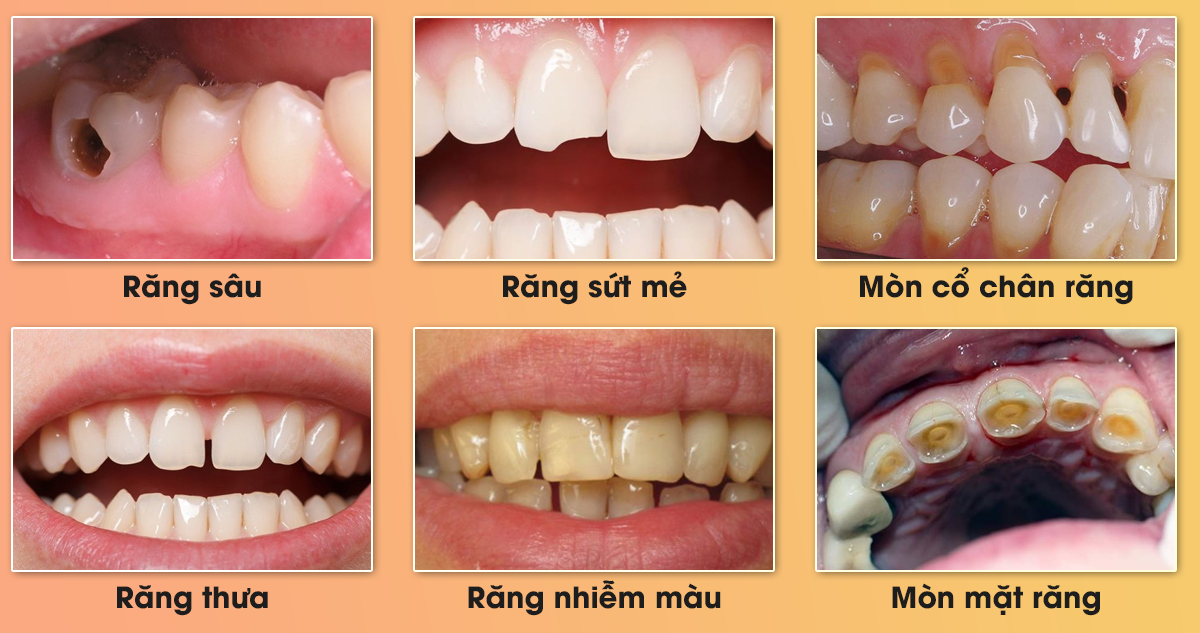 Các trường hợp nên trám răng thẩm mỹ - Nha khoa Tâm Như - Quận 10 - Tp. Hồ Chí Minh