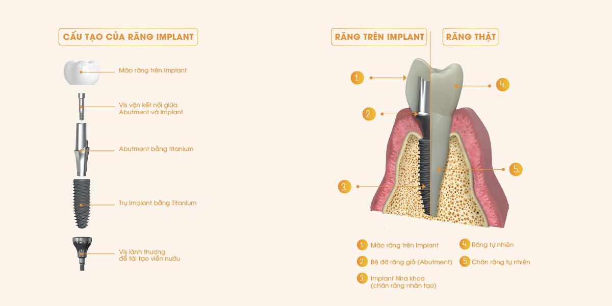 cấu tạo răng Implant Nha khoa
