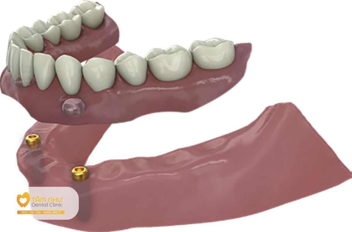Cấy ghép Implant phục hình toàn hàm tháo lắp thay thế toàn bộ răng - Nha Khoa Tâm Như - Quận 10 - Tp. Hồ Chí Minh