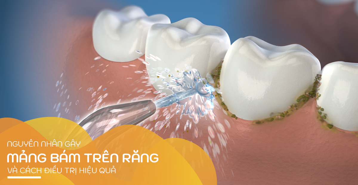 Nguyên nhân gây mảng bám trên răng và cách điều trị hiệu quả | nha khoa Tâm Như - Quận 10