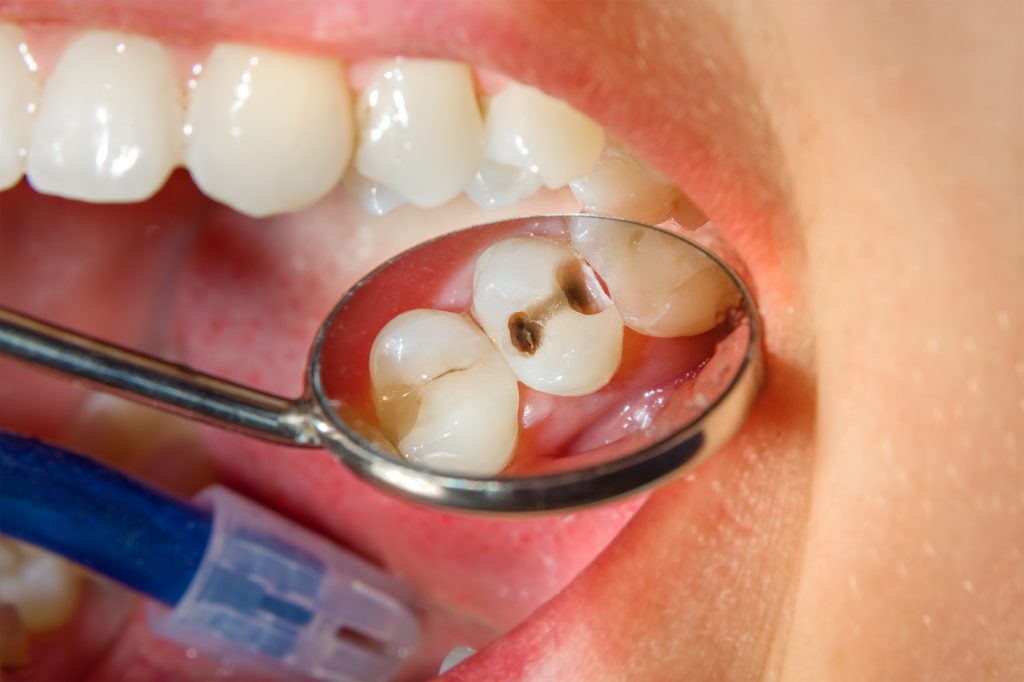 Sâu răng | nha khoa Tâm Như - Quận 10