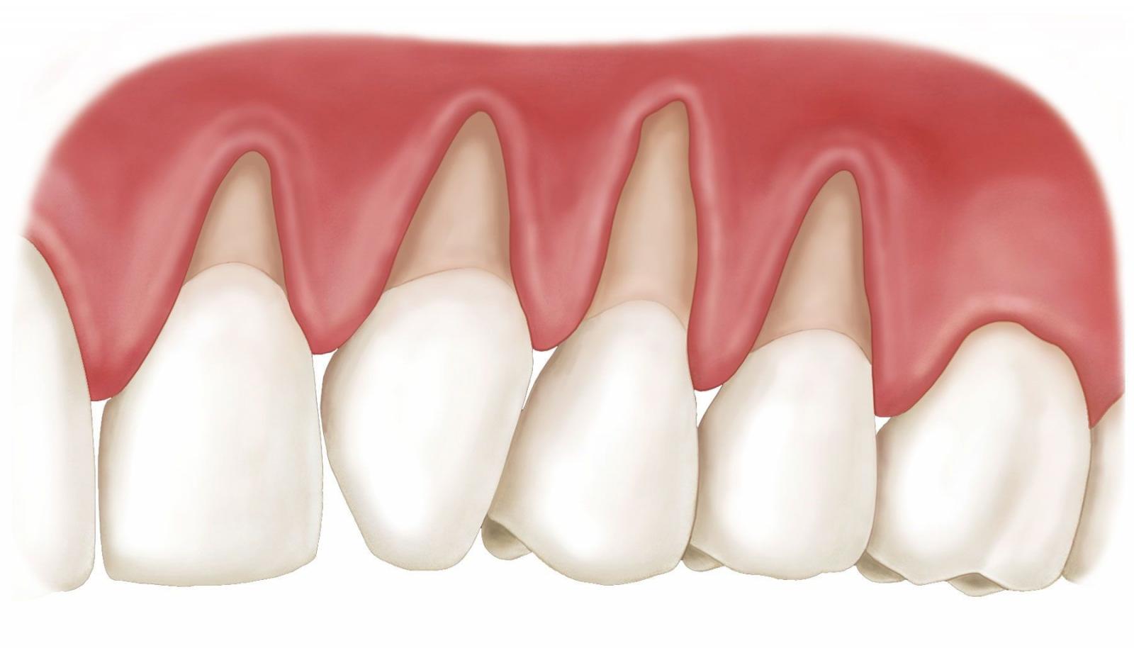 Hiện tượng tụt nướu răng | Nha khoa Tâm Như - Quận 10