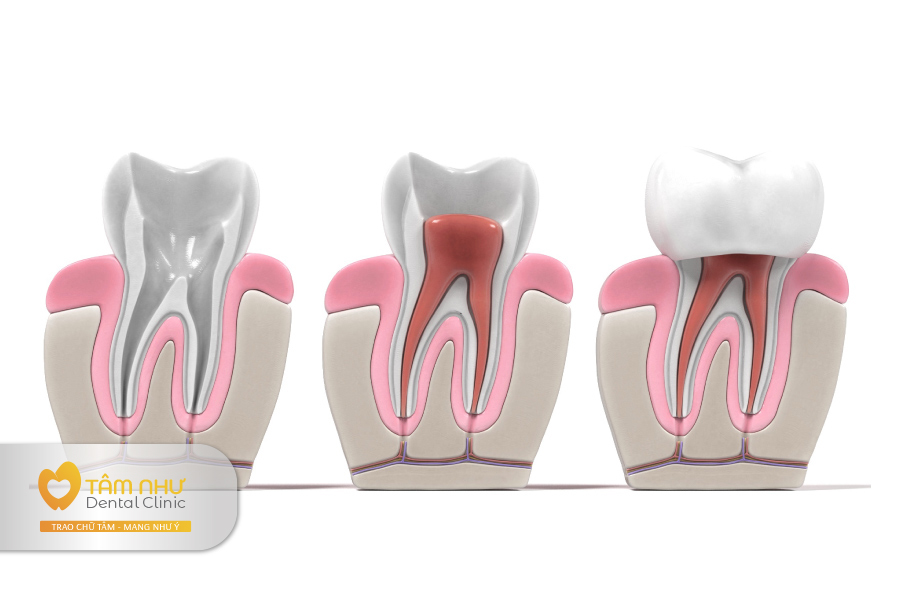 Bọc sứ răng sau - Cách bảo tồn răng thật cho những răng bị sâu nặng