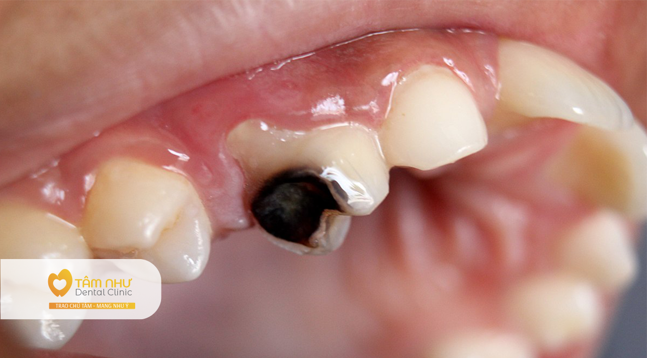 Những cách phát hiện sau răng dễ thấy nhất