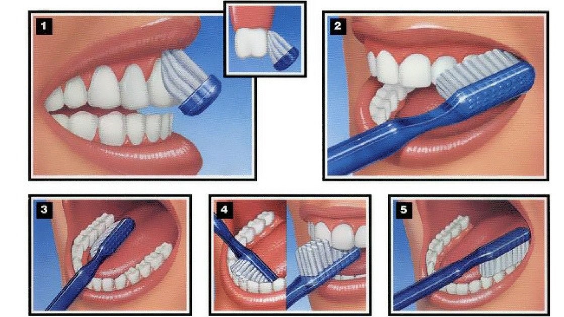 Đánh răng đúng cách giúp phòng ngừa tụt mướu răng | Nha khoa Tâm Như - Quận 10