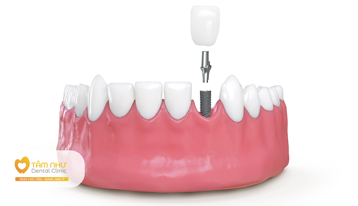 Cấy ghép Implant thay thế răng đã mất giúp phòng ngừa tụt mướu răng | Nha khoa Tâm Như - Quận 10