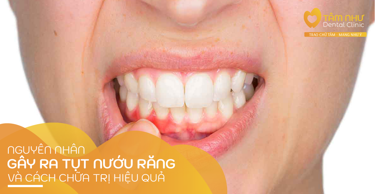 Nguyên nhân gây tụt nướu răng và cách chữa trị hiệu quả | nha khoa Tâm Như - Quận 10