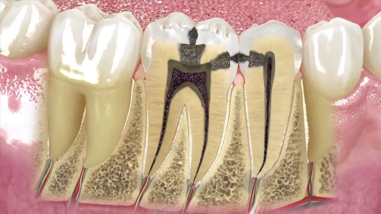 Sâu răng gây ra đau răng
