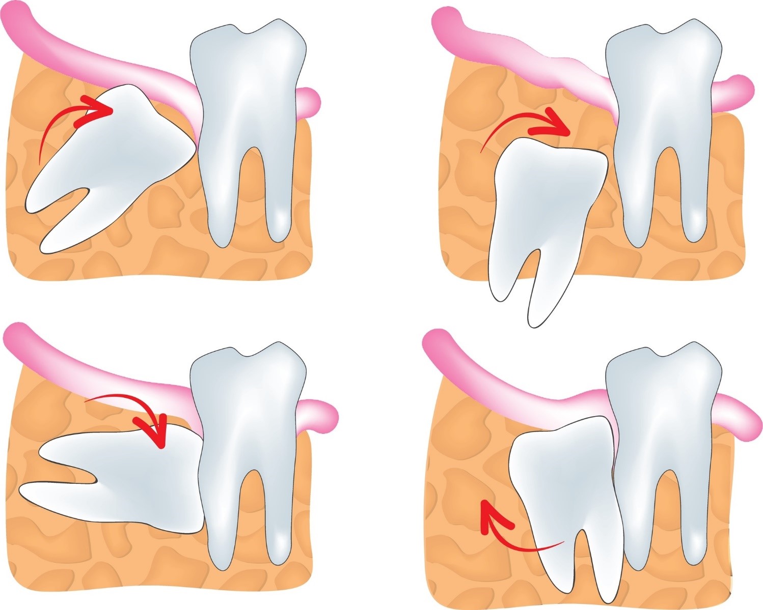 Răng khôn mọc lêch gây ra đau răng