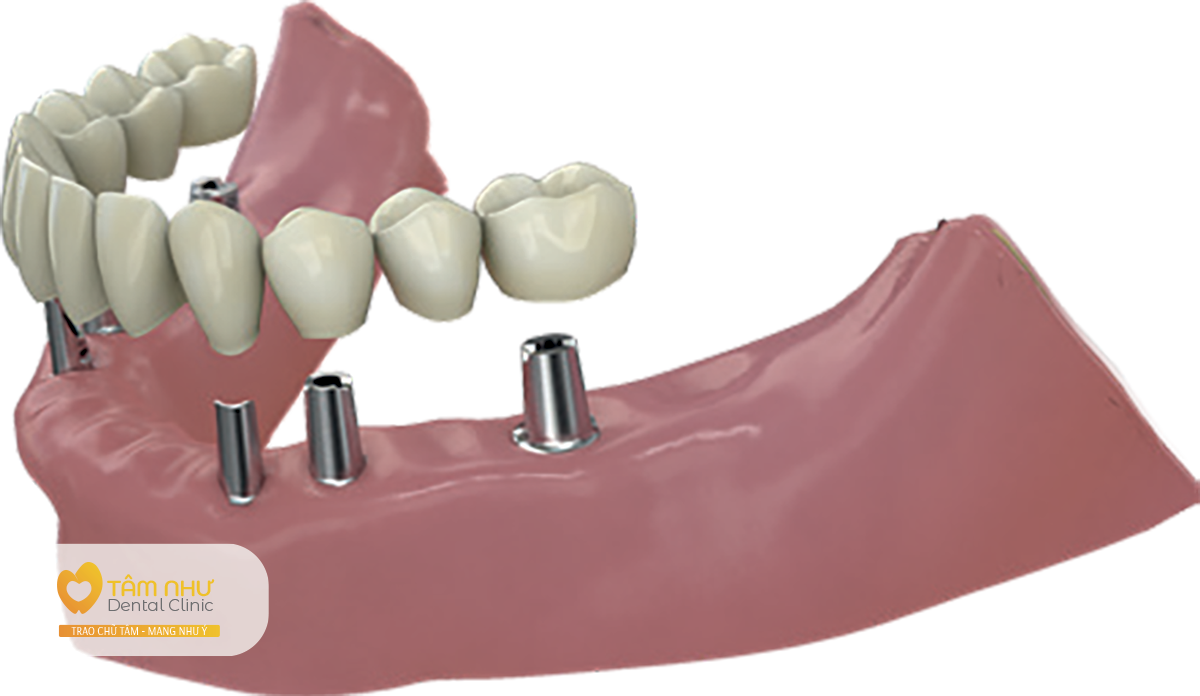 Cấy ghép Implant phục hình răng đơn và cầu răng thay thế toàn bộ răng - Nha Khoa Tâm Như - Quận 10 - Tp. Hồ Chí Minh