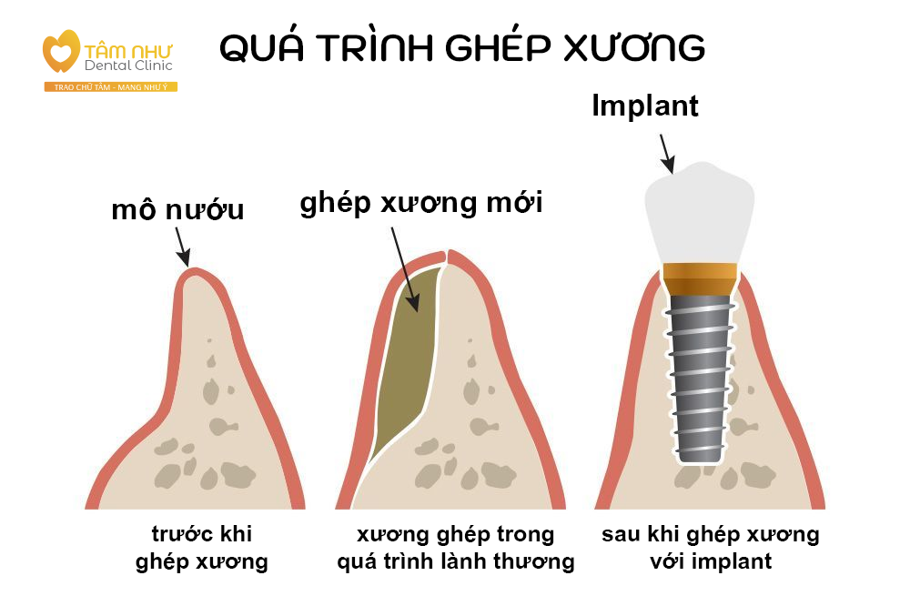 ghép xương để cấy ghép Implant - Nha Khoa Tâm Như - Quận 10 - Tp. Hồ Chí Minh