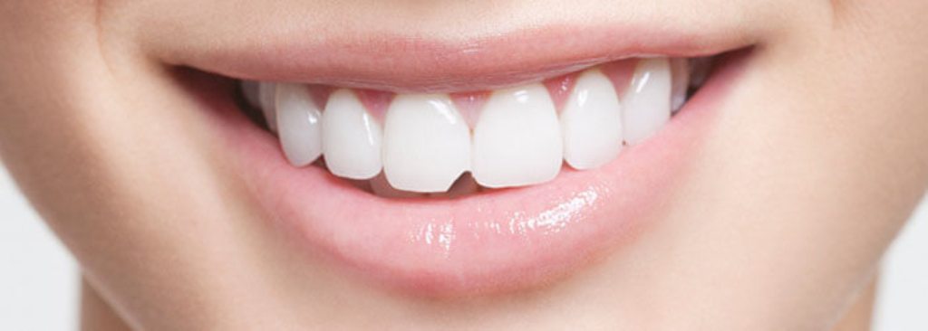 Răng bị mẻ | nha khoa Tâm Như - Quận 10