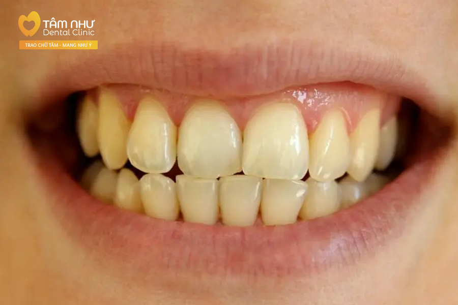 Răng ố vàng có thể tấy trắng răng | Nha khoa Tâm Như - Quận 10