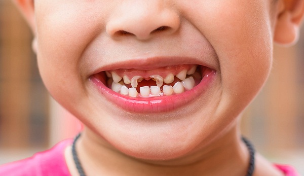Mảng bám trên răng gây nên sâu răng | nha khoa Tâm Như - Quận 10