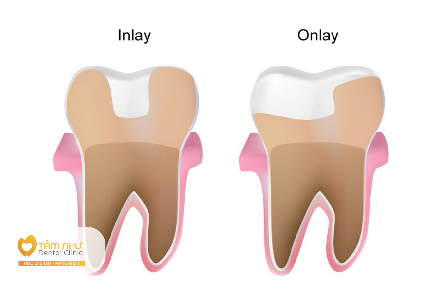 Trám răng Inlay/ Onlay - Hoàn hảo phục hồi cho những răng bị sâu tối thiểu