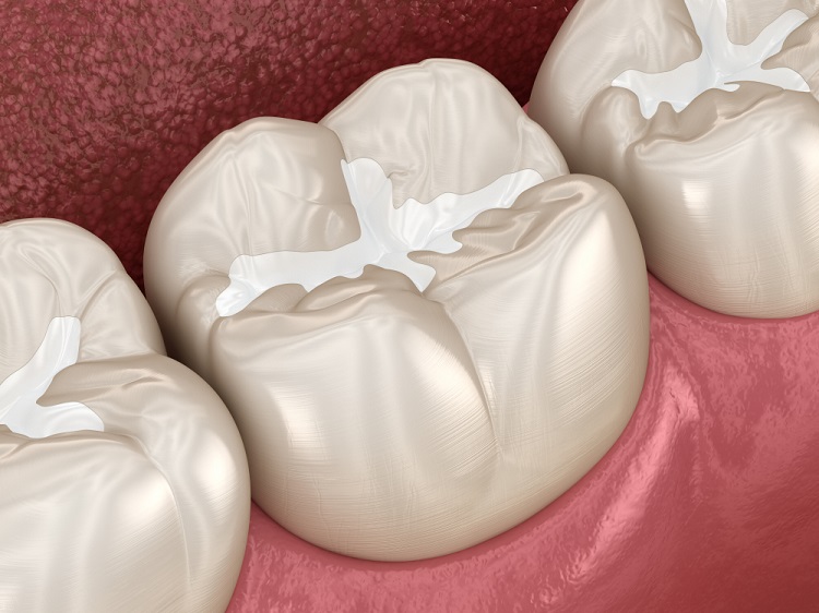 cách phục hồi men răng