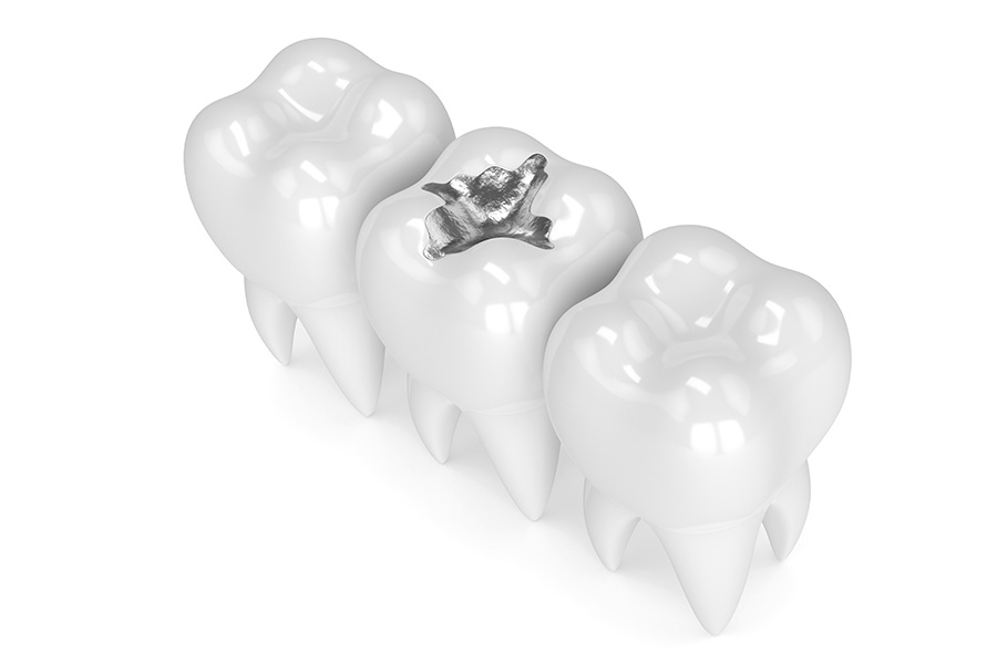 điều trị răng bị mẻ bằng cách trám răng