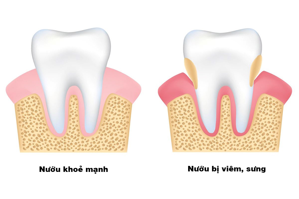 Hiện tượng tụt nướu răng | Nha khoa Tâm Như - Quận 10