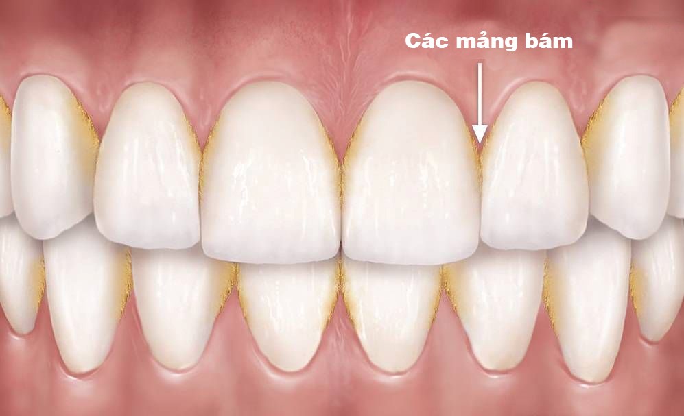 Mảng bám trên răng | nha khoa Tâm Như - Quận 10