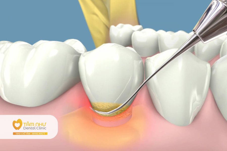Mảng bám hình thành trên răng sẽ tạo nên vôi răng | nha khoa Tâm Như